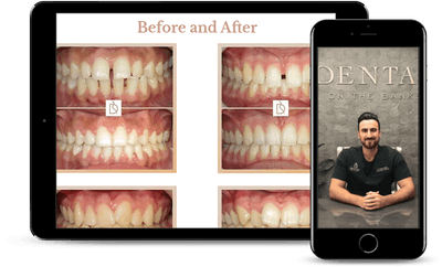 Invisalign video consultation on a phone and tablet